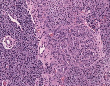 Biopsy specimen of a glioblastoma